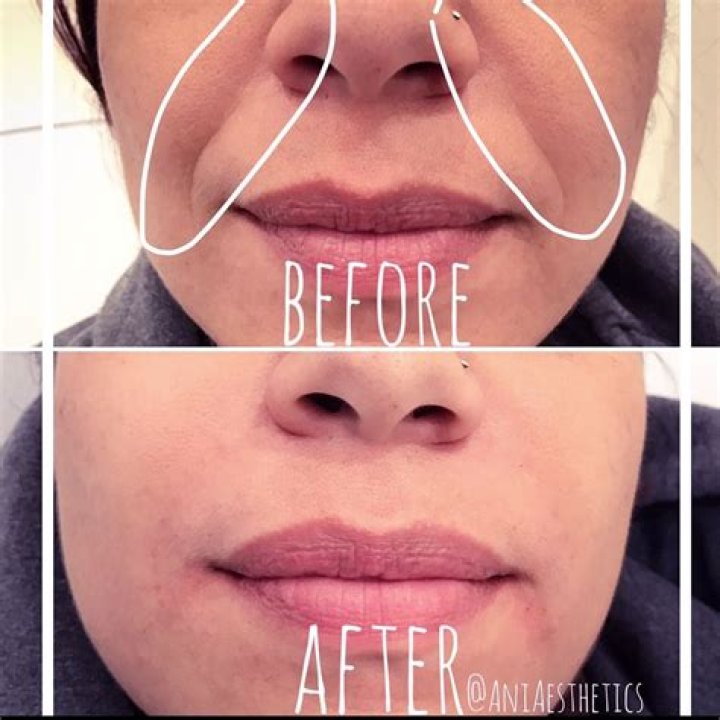How to get rid of smile lines
